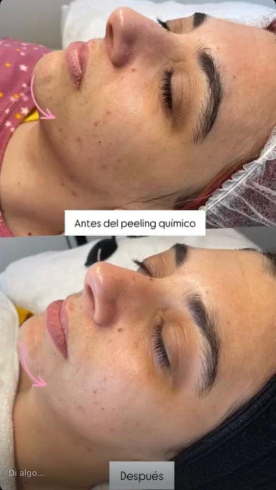 Imagen numero 2 del servicio Peeling químico Coreano Despigmentante