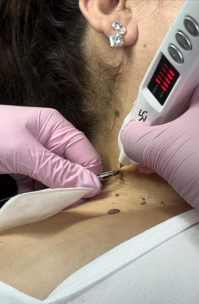 Imagen numero 1 del servicio Retiro de Acocordones (lunares de carne)