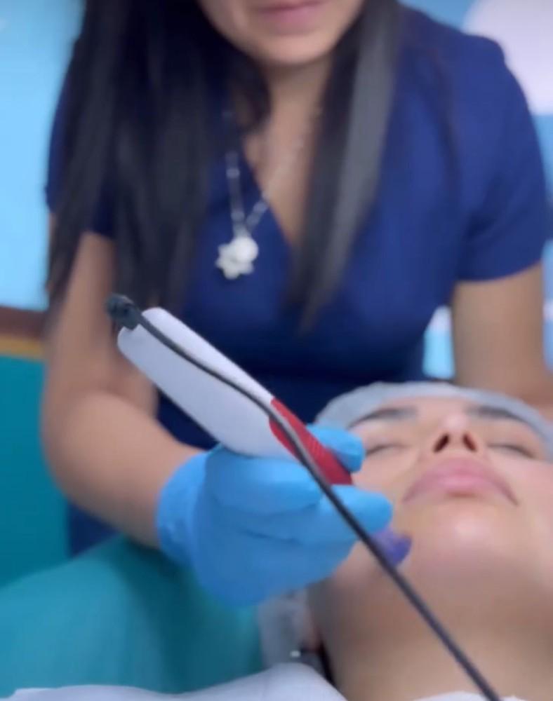 Imagen numero 1 del servicio Dermapen