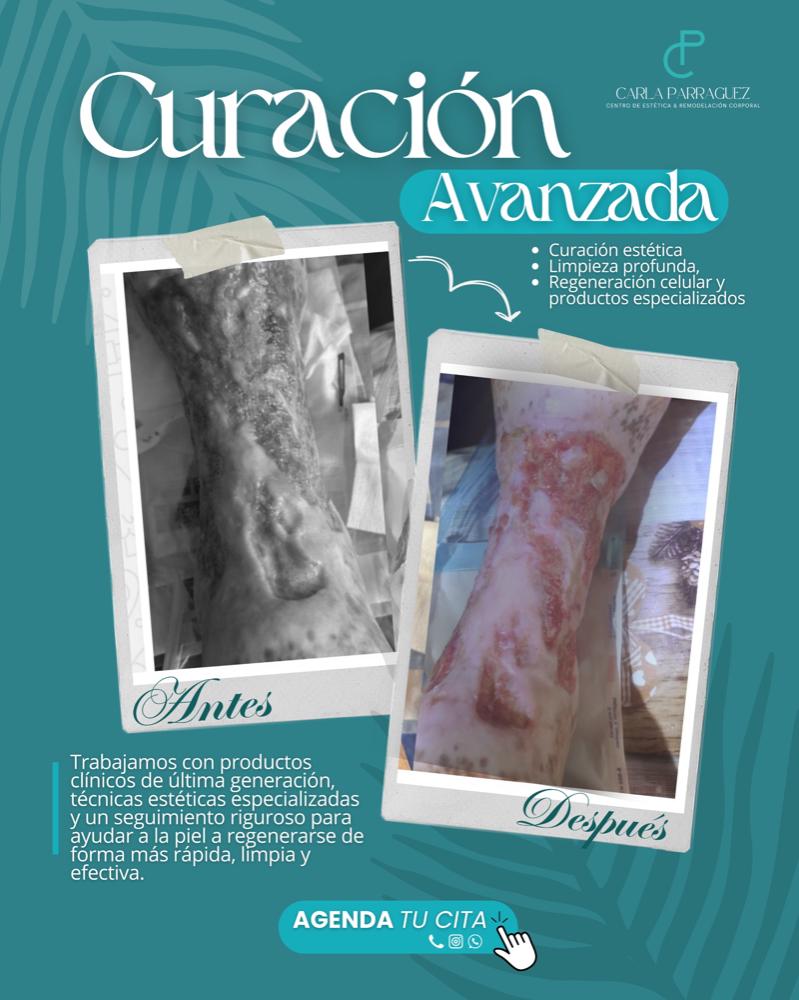 Imagen numero 1 del servicio Curación Avanzada